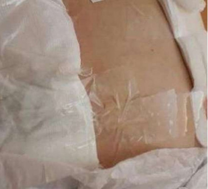 Ancheta la un spital din Rusia, dupa ce medicii au lipit cu scotch o pacienta dupa operatie