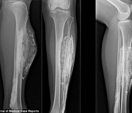 Ce a descoperit o femeie la 50 de ani dupa ce a fost muscata de un sarpe. Medicii au incercat sa gaseasca o explicatie