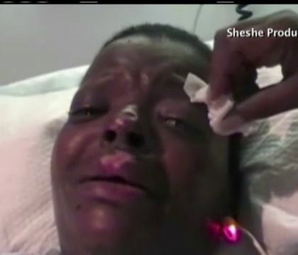 Dramele prin care au trecut doua femei din SUA care si-au injectat in organism silicon si fibra de sticla Dramele prin care au trecut doua femei din SUA care si-au injectat in organism silicon si fibra de sticla