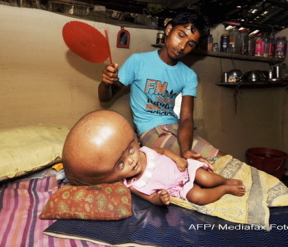 Doctorii au fost surprinsi sa afle ca inca este in viata. Cum arata dupa 1 an fetita din India care a impresionat lumea