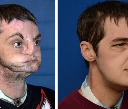 "Nu se mai uita nimeni crucis la mine". Barbatul care a suferit cel mai dramatic implant de fata este model de revista "Nu se mai uita nimeni crucis la mine". Barbatul care a suferit cel mai dramatic implant de fata este model de revista