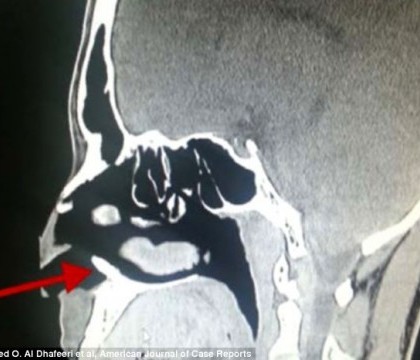 FOTO. A mers la spital din cauza unor probleme nazale. Descoperirea facuta la radiografie i-a surprins si pe medici FOTO. A mers la spital din cauza unor probleme nazale. Descoperirea facuta la radiografie i-a surprins si pe medici
