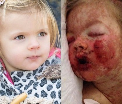 Reactia provocata de un medicament pe care il iau toti copiii. Fetita de 2 ani a stat 10 zile la Terapie Intensiva