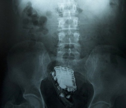 Un britanic a murit de rusine. Ce n-a avut curaj sa recunoasca in fata medicilor Un britanic a murit de rusine. Ce n-a avut curaj sa recunoasca in fata medicilor