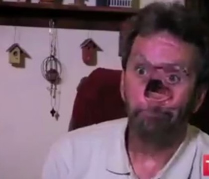 Si-a sarutat din nou sotia dupa 10 ani. Cum arata barbatul cu chipul mutilat de cancer dupa reconstructia faciala Si-a sarutat din nou sotia dupa 10 ani. Cum arata barbatul cu chipul mutilat de cancer dupa reconstructia faciala