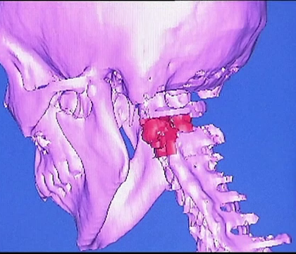 Premiera in medicina: prima vertebra obtinuta cu ajutorul unei imprimante 3D, implantata unui copil