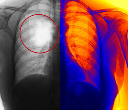 46% dintre bolnavii de cancer sunt diagnosticati prea tarziu. Studiul realizat de catre britanici arata o eroare uriasa din sistem 46% dintre bolnavii de cancer sunt diagnosticati prea tarziu. Studiul realizat de catre britanici arata o eroare uriasa din sistem
