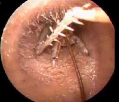 VIDEO. S-a dus la spital cu o mancarime in ureche. Vietatea pe care medicii au gasit-o in canalul auditiv VIDEO. S-a dus la spital cu o mancarime in ureche. Vietatea pe care medicii au gasit-o in canalul auditiv