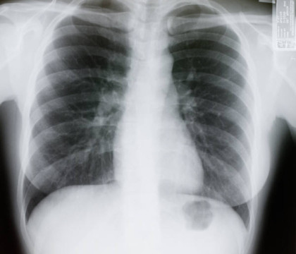 Se plangea de dureri in gat si lesina des. Medicii au inlemnit cand s-au uitat pe radiografie: ce inghitise baiatul. FOTO
