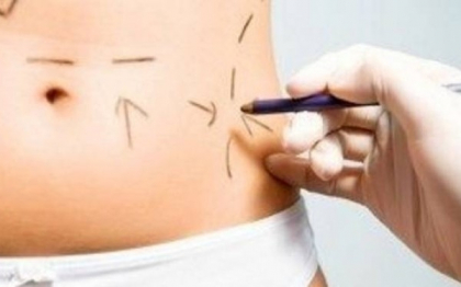 A fost desfigurata dupa o interventie estetica banala. Cum arata abdomenul femeii dupa liposuctie A fost desfigurata dupa o interventie estetica banala. Cum arata abdomenul femeii dupa liposuctie