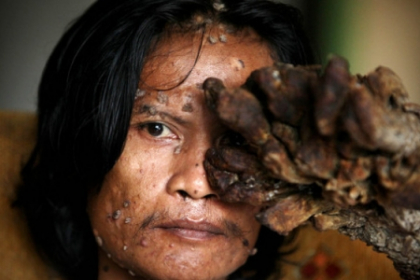 Povestea trista a omului copac. Calvarul la care este condamnat din cauza unei boli incurabile Povestea trista a omului copac. Calvarul la care este condamnat din cauza unei boli incurabile