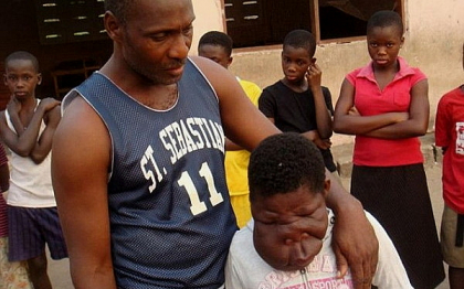 Fetita de 13 ani din Ghana cu o diformitate faciala extrema va fi operata. FOTO Fetita de 13 ani din Ghana cu o diformitate faciala extrema va fi operata. FOTO