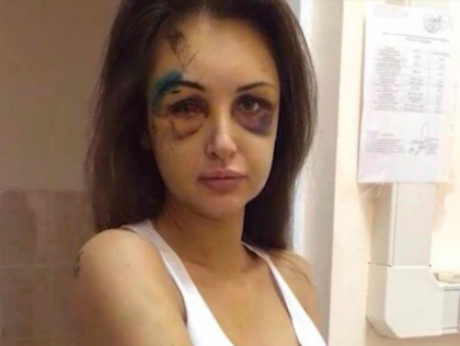 Iubita unui milionar rus: "Eram ca un zombie din filmele horror". Cum arata tanara dupa ce a fost batuta de partener Iubita unui milionar rus: "Eram ca un zombie din filmele horror". Cum arata tanara dupa ce a fost batuta de partener