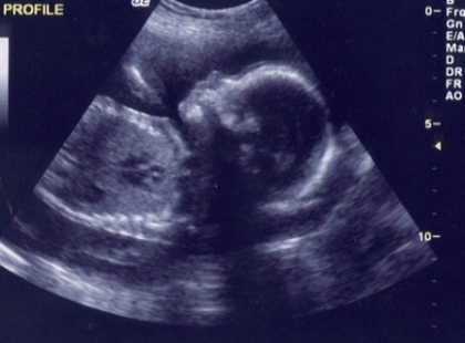 Ce a aratat un bebelus nenascut, in timpul ecografiei. Mama: "Copilul acesta imi va face probleme" Ce a aratat un bebelus nenascut, in timpul ecografiei. Mama: "Copilul acesta imi va face probleme"