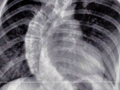 Medicii au fost UIMITI cand au vazut radiografia unei fete de 13 ani. Coloana vertebrala era curbata la 90 de grade Medicii au fost UIMITI cand au vazut radiografia unei fete de 13 ani. Coloana vertebrala era curbata la 90 de grade