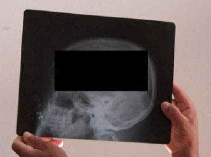 Socant: Dupa 19 ani a scapat de durerile de cap. Ce au gasit medicii in CRANIUL unui barbat - FOTO Socant: Dupa 19 ani a scapat de durerile de cap. Ce au gasit medicii in CRANIUL unui barbat - FOTO