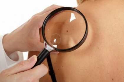 Alunitele care te trimit urgent la medic. Cand trebuie sa te ingrijorezi! FOTO Alunitele care te trimit urgent la medic. Cand trebuie sa te ingrijorezi! FOTO