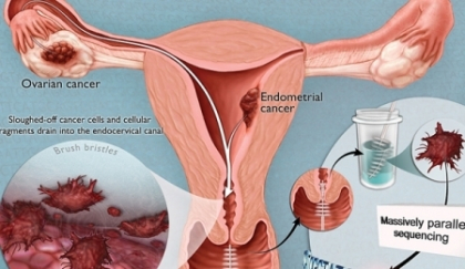Cancerul ovarian: 6 informatii importante care-ti pot salva viata
