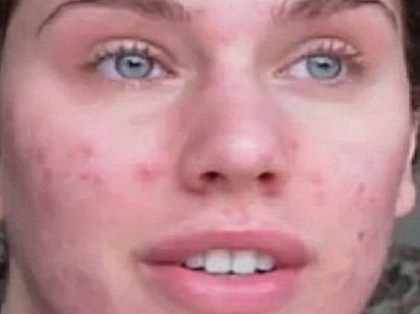 O tanara cu chipul devastat de acnee a ajuns model. Cum a devenit celebra pe internet - VIDEO