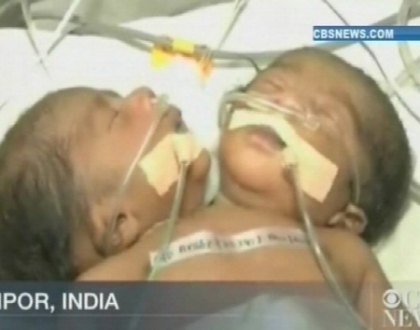 Caz extrem de rar, inregistrat in India. O femeie a nascut un copil cu doua capete Caz extrem de rar, inregistrat in India. O femeie a nascut un copil cu doua capete