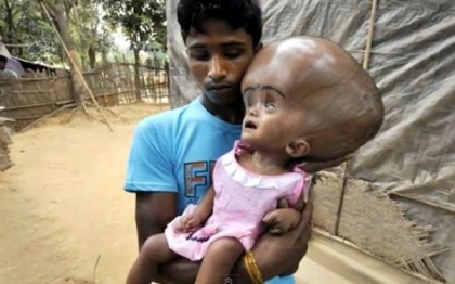 Cum arata in prezent fata de trei ani din India care sufera de o forma rara de hidrocefalie Cum arata in prezent fata de trei ani din India care sufera de o forma rara de hidrocefalie