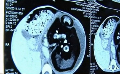 Cazul care a uimit lumea medicala. Un baiat de 2 ani l-a nascut pe propriul sau frate. VIDEO Cazul care a uimit lumea medicala. Un baiat de 2 ani l-a nascut pe propriul sau frate. VIDEO