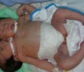 O femeie din Vietnam a nascut un copil cu doua capete si trei maini O femeie din Vietnam a nascut un copil cu doua capete si trei maini