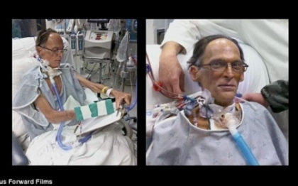 Caz medical uluitor: un barbat traieste FARA INIMA. Cum circula sangele prin corpul lui. VIDEO