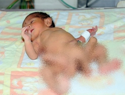 Un copil cu 6 picioare, fiul unui radiolog, ar putea fi salvat de medici. Imagini necenzurate