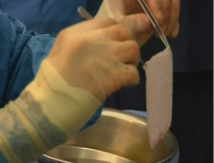 Transplant inedit in Africa. Medicii au clonat pielea unei fetite si i-au transplantat-o Transplant inedit in Africa. Medicii au clonat pielea unei fetite si i-au transplantat-o