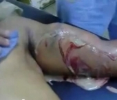 VIDEO SOCANT. Ce a patit un barbat care si-a injectat steroizi in brate VIDEO SOCANT. Ce a patit un barbat care si-a injectat steroizi in brate