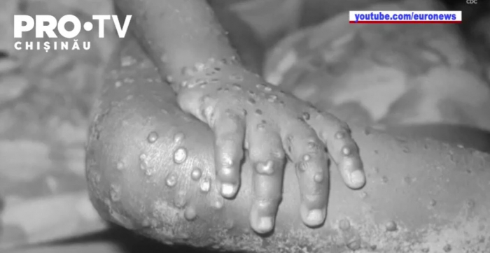 ANSP assures that in the Republic of Moldova there have been no confirmed or suspected cases of monkeypox