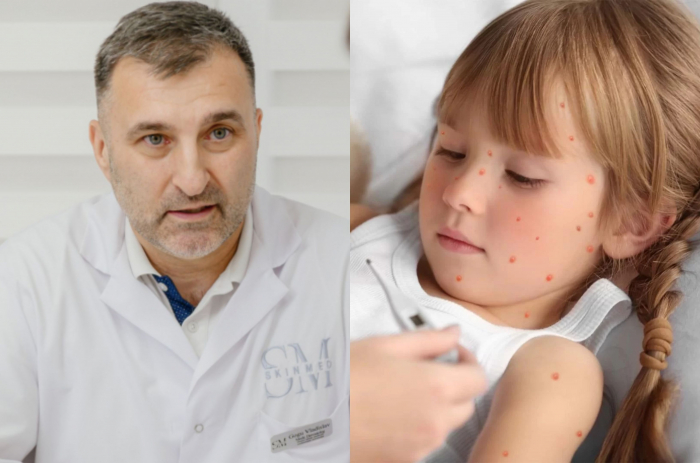 Preventing Scars from Chicken Pox: Tips from Dermato-Venereology Doctor Vladislav Gogu
