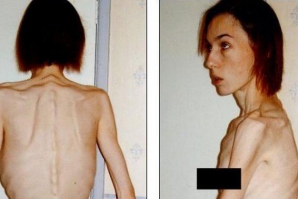 Cantarea doar 34 de kg! Transformarea spectaculoasa a tinerei care suferea de anorexie - FOTO Cantarea doar 34 de kg! Transformarea spectaculoasa a tinerei care suferea de anorexie - FOTO