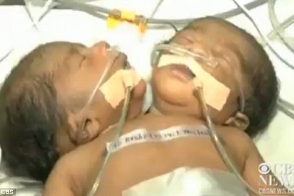 Un copil cu doua capete s-a nascut in India. Medicii spera sa faca o minune - FOTO Un copil cu doua capete s-a nascut in India. Medicii spera sa faca o minune - FOTO