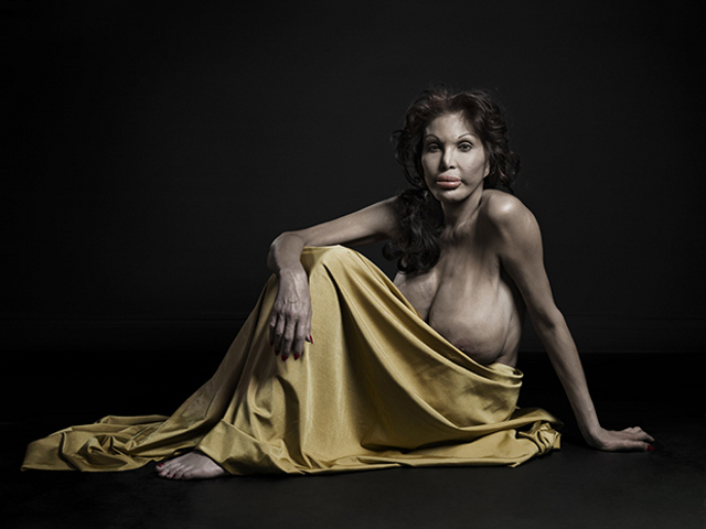 Operatii estetice exagerate! Ce se intampla cand chirurgia plastica devine obsesie! FOTO socante
