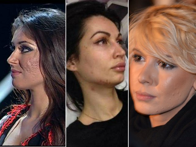 Acneea la vedete! Cine sunt divele care au dus o lupta crancena cu cosurile - FOTO