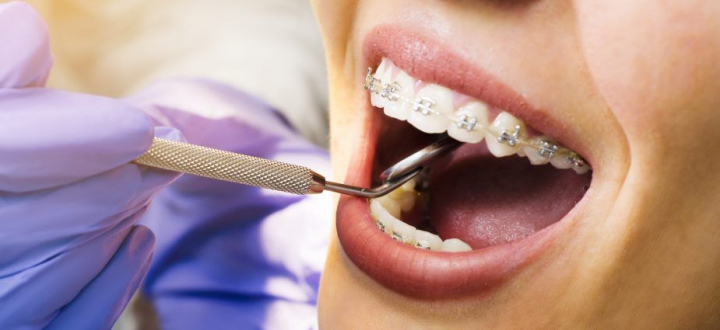 Primele zile cu aparat dentar: cum depasim orice disconfort Primele zile cu aparat dentar: cum depasim orice disconfort