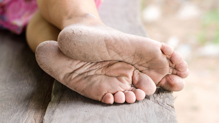 Cum sa eviti principalele cauze care duc la craparea calcaielor Cum sa eviti principalele cauze care duc la craparea calcaielor