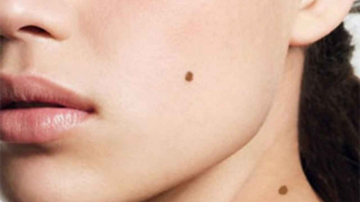 Harta alunitelor de pe corp. Ce prevestesc ele? Harta alunitelor de pe corp. Ce prevestesc ele?