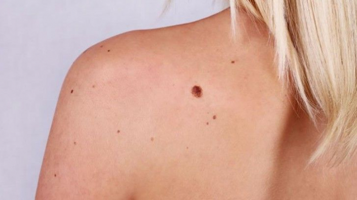 Tot ce trebuie sa stii despre alunite sau nevi. Cezara BOLOCAN, MEDIC DERMATO-VENEROLOG, COSMETOLOG: „Daca timp de trei-sase luni, negii se multiplica, atunci sigur recurgem la tratament.”