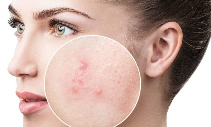 Cum scapi de acnee. Afla de la cosmetolog despre tratametnul acesteia cu laser: "Actiunea termica a laserului are un efect puternic antibacterian, care duce la la distrugerea inflamatiilor". Povestea unei tinere care a scapat de problema estetica a tenului - VIDEO