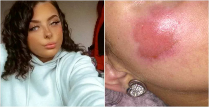 Tanara de 17 ani care traieste un adevarat cosmar! A ramas cu arsuri pe fata dintr-un motiv pur si simplu incredibil! Ce s-a intamplat