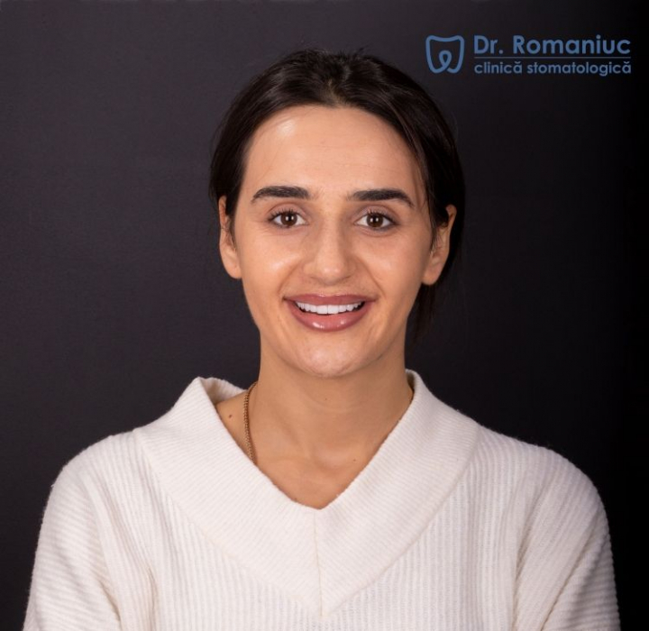 Estetica dentara care iti poate schimba radical zambetul. Afla care sunt indicatiile pentru fatetele dentare Estetica dentara care iti poate schimba radical zambetul. Afla care sunt indicatiile pentru fatetele dentare