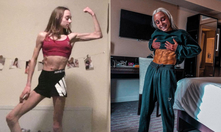 Cum a ajuns o tanara sa invinga anorexia. Transformarea ei este cu totul spectaculoasa - FOTO
Cum a ajuns o tanara sa invinga anorexia. Transformarea ei este cu totul spectaculoasa - FOTO