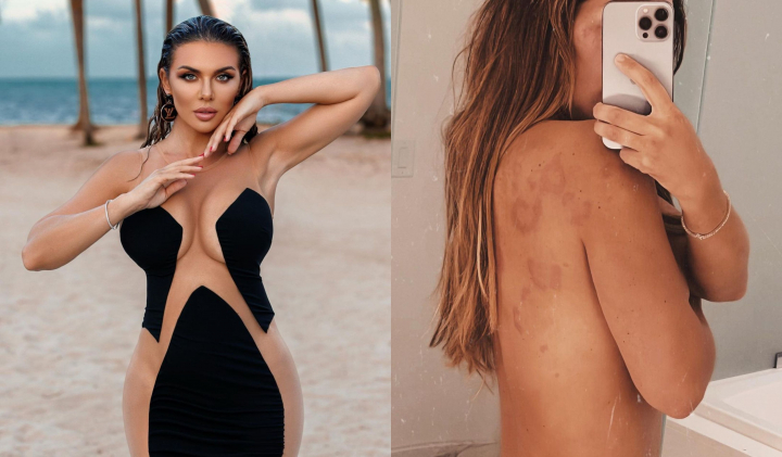 Anna Sedokova a dezvaluit ca sufera de o afectiune a pielii: „Trebuie sa dai o mie de dolari pe o injectie, pe care apropo nici nu o gasesti atat de usor” - FOTO Anna Sedokova a dezvaluit ca sufera de o afectiune a pielii: „Trebuie sa dai o mie de dolari pe o injectie, pe care apropo nici nu o gasesti atat de usor” - FOTO