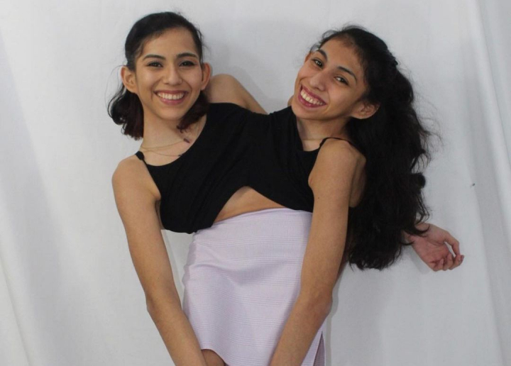 Povestea gemenelor siameze Carmen si Lupita Andrade. Cum arata viata lor la 22 de ani Povestea gemenelor siameze Carmen si Lupita Andrade. Cum arata viata lor la 22 de ani