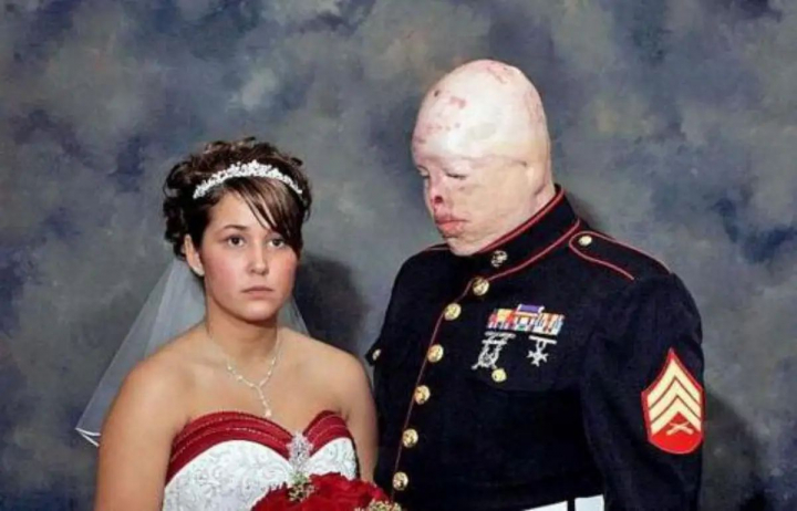 Chiar daca a ramas mutilat pe viata, iubita lui i-a ramas alaturi. Afla povestea de dragoste care te va uimi - FOTO Chiar daca a ramas mutilat pe viata, iubita lui i-a ramas alaturi. Afla povestea de dragoste care te va uimi - FOTO