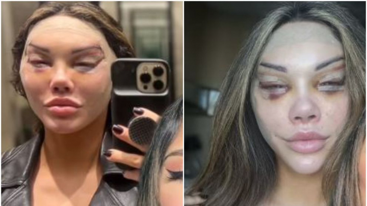 S-a operat ca sa isi faca „ochi de pisica” si a trecut prin chinuri groaznice: „Aratam ca un cadavru” - FOTO S-a operat ca sa isi faca „ochi de pisica” si a trecut prin chinuri groaznice: „Aratam ca un cadavru” - FOTO