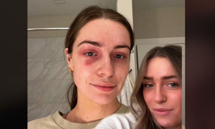 Cauza surprinzătoare pentru care o femeie a făcut o alergie de care nu a scăpat 6 luni. Simptomele i-au dispărut apoi peste noapte
Cauza surprinzătoare pentru care o femeie a făcut o alergie de care nu a scăpat 6 luni. Simptomele i-au dispărut apoi peste noapte